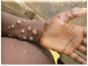 RDC : vaccination contre le mpox pour 600 000 personnes