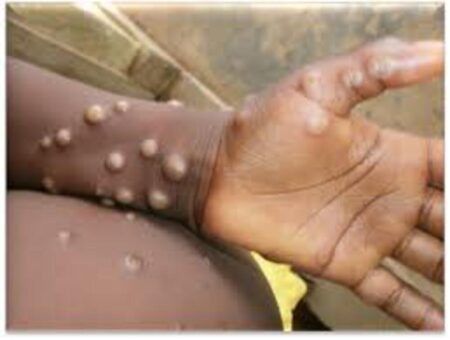Sierra Léone : vers une meilleure surveillance génomique du Mpox