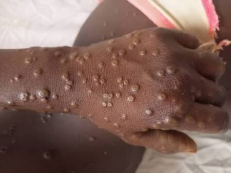 Nigéria/Mpox: surveillance et données renforcées
